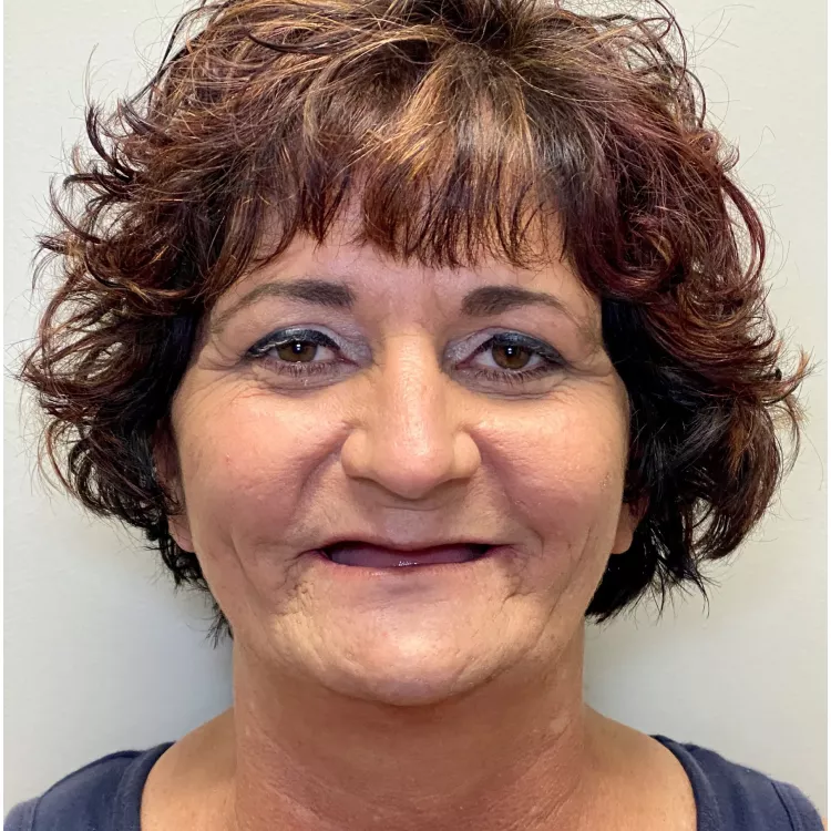 A patient's before image smiling.