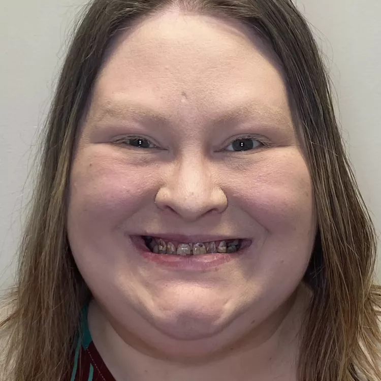 A patient's before image smiling.